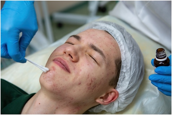Acne Treatment Procedure